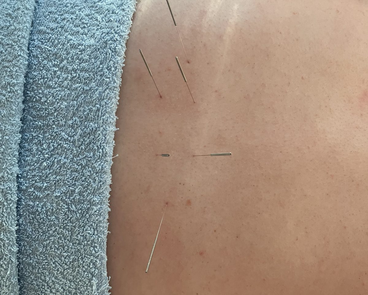Acupuncture needles placed along the back during treatment
