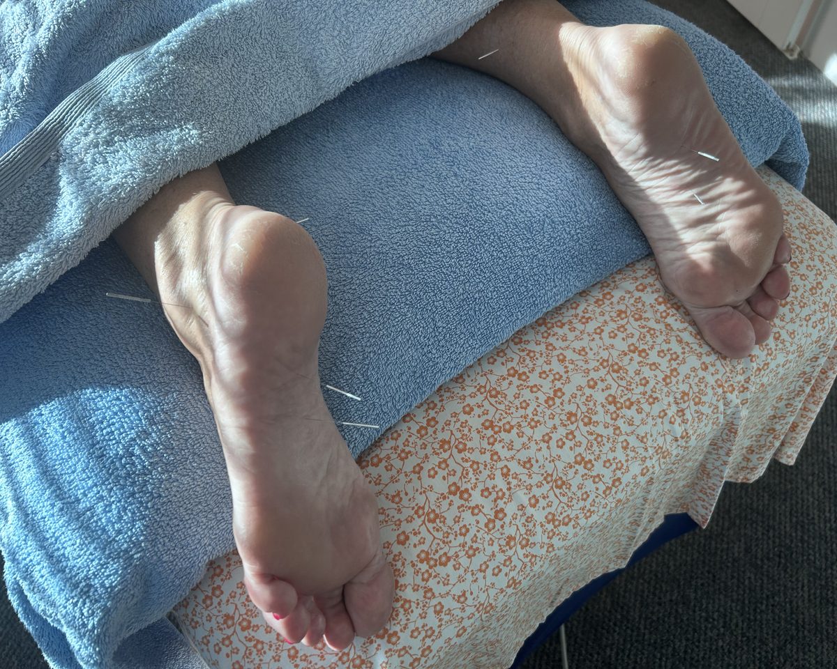Acupuncture needles placed in the feet during treatment