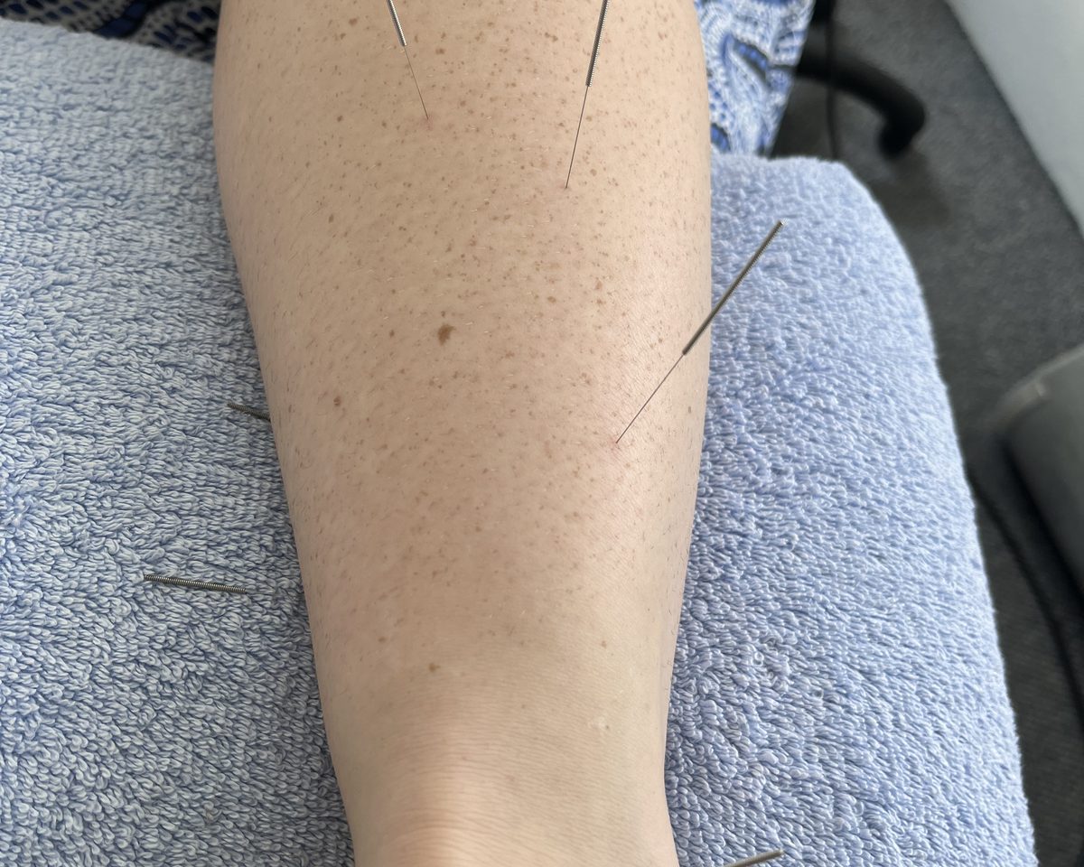Acupuncture needles placed along the lower leg