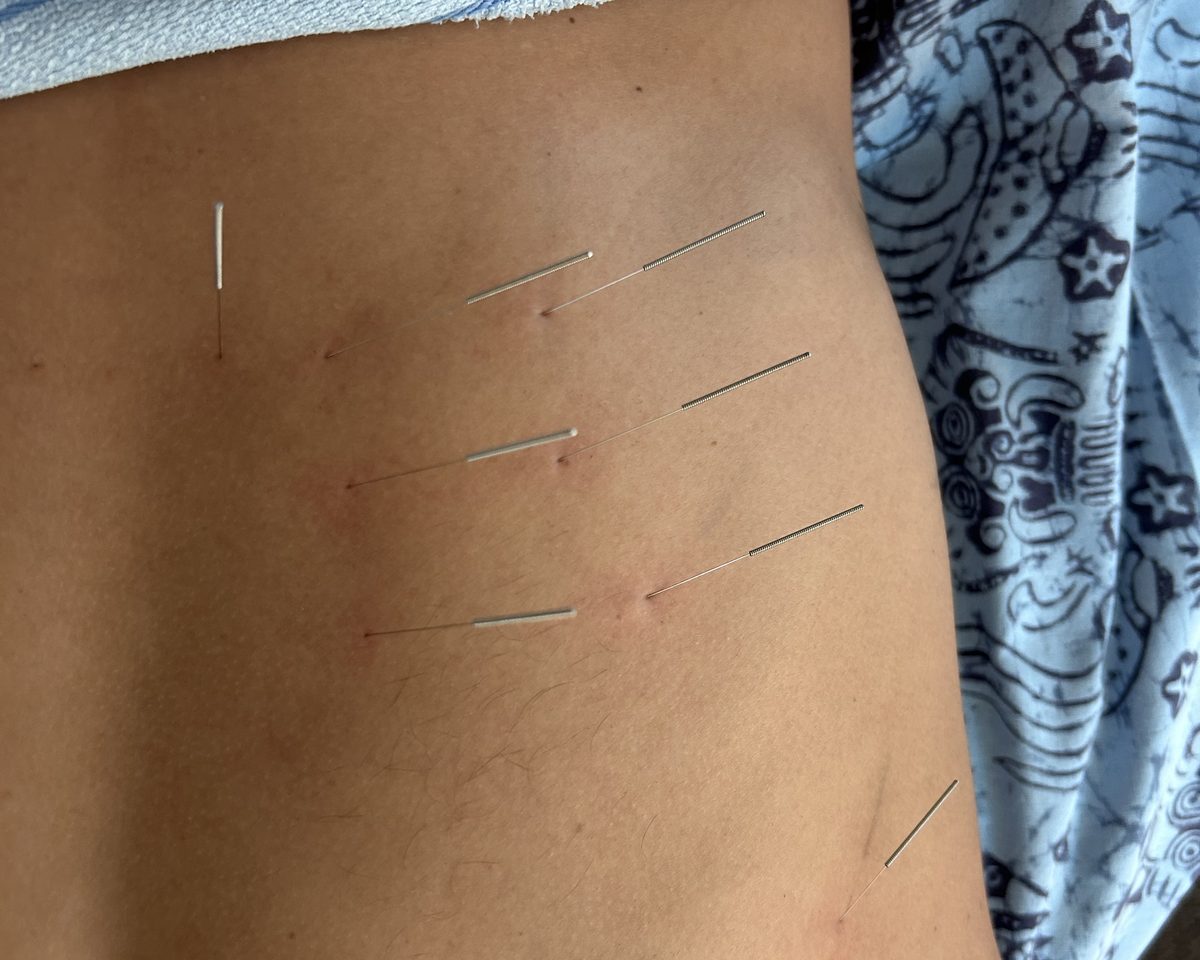 Acupuncture needles placed across the lower back