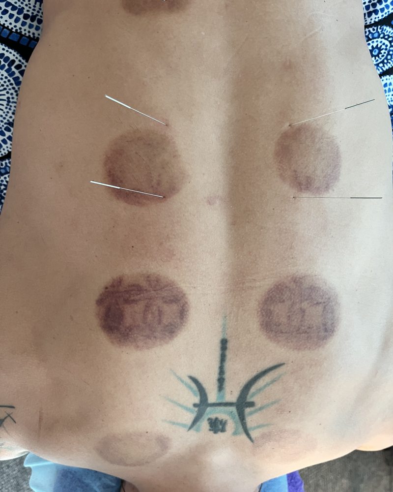 Cupping marks on the lower back after a cupping treatment