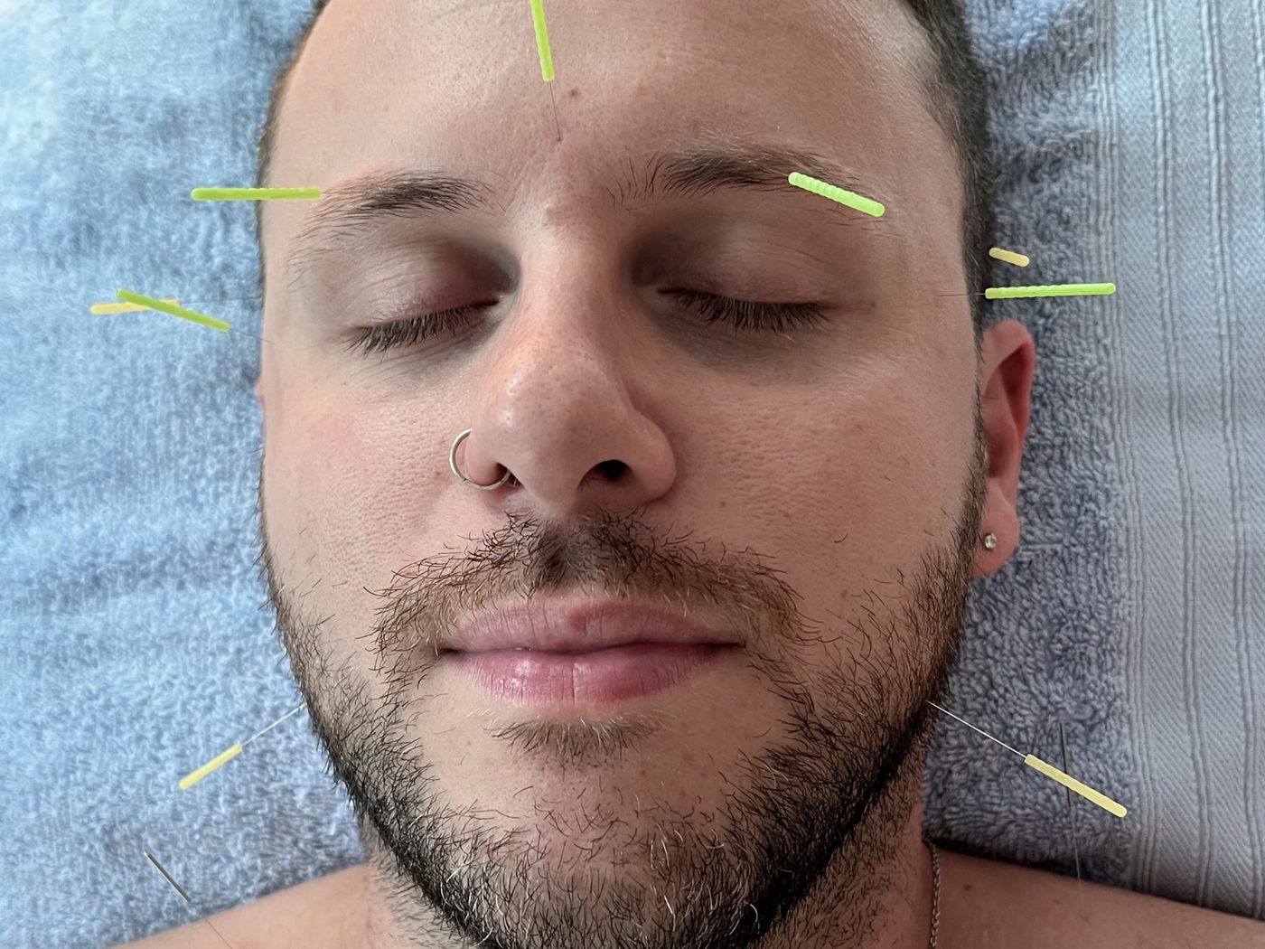 Facial acupuncture treatment at Vantage Point Acupuncture