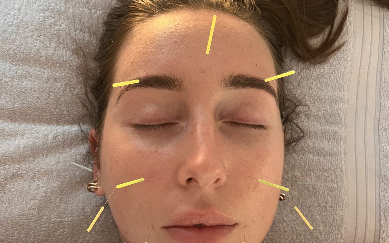 Facial acupuncture needles placed on the face during treatment