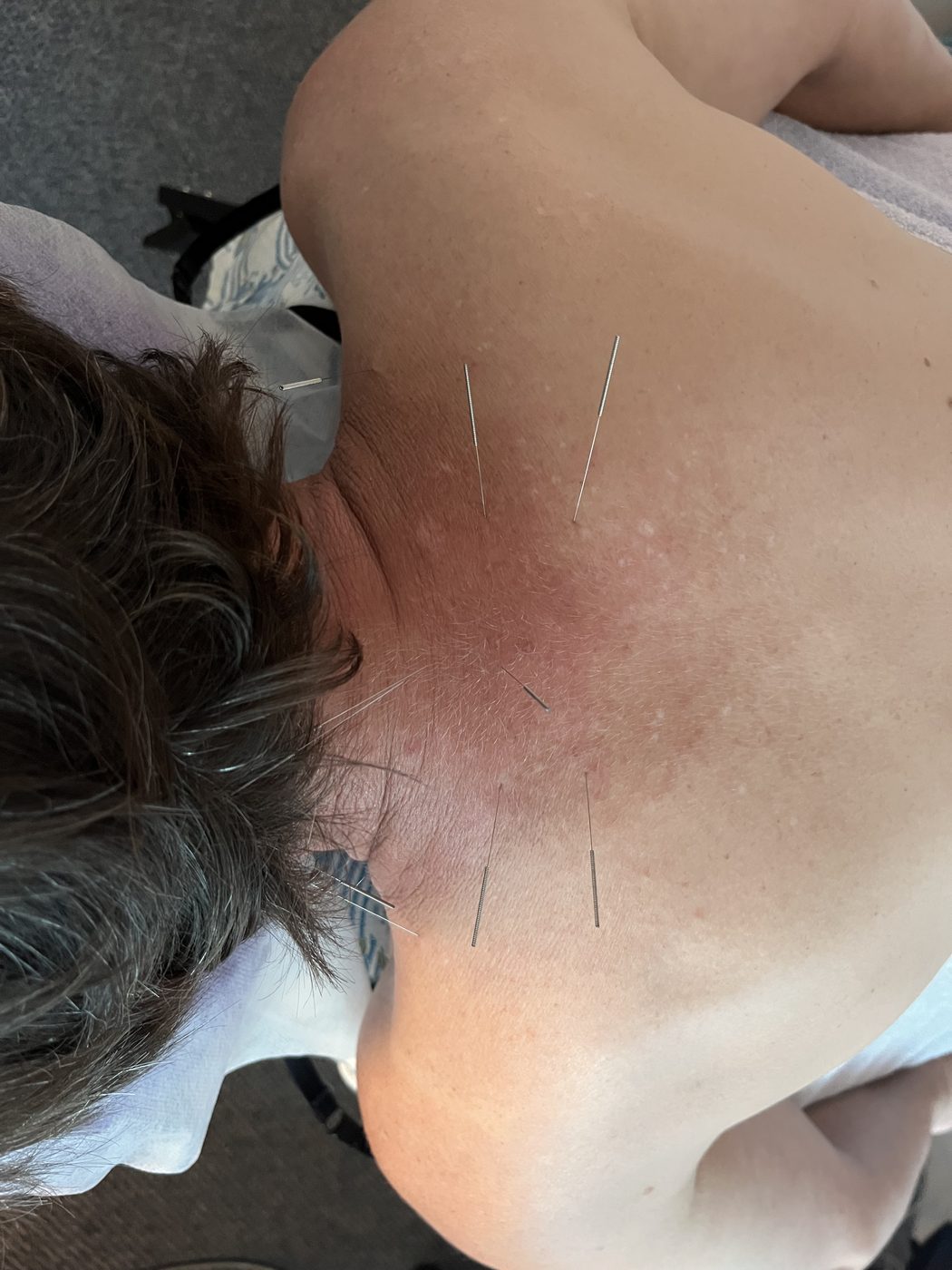 Acupuncture needles placed along the neck and shoulder at Vantage Point Acupuncture